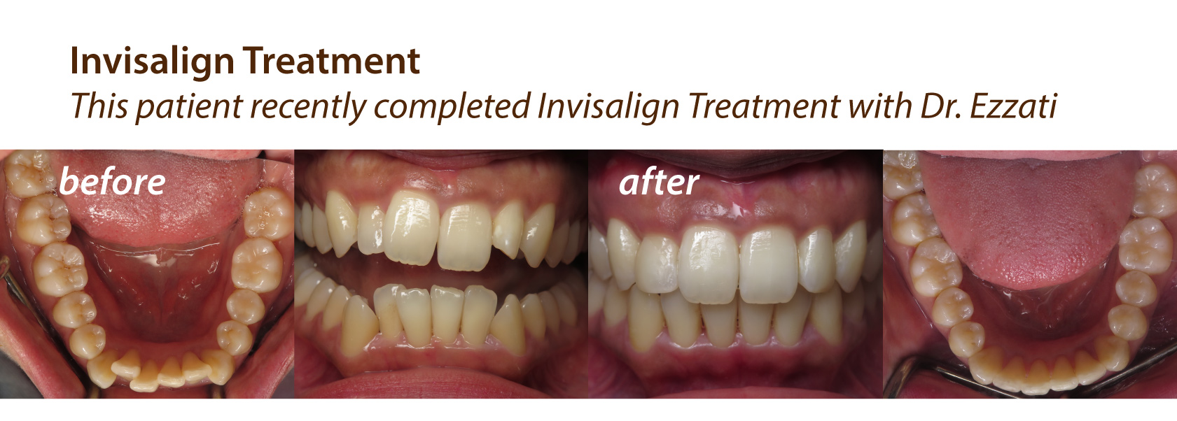 Orthodontics Traditional Or Clear Braces